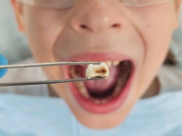Best Emergency Tooth Extraction in Denver, IA